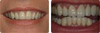 Sourire après pose de facette : facettes céramiques sur les dents supérieures et inférieures