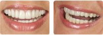 Restauration du sourire : sourire après traitement par deux bridges céramiques complets supérieur et inférieur