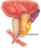 http://urology.med-visit.com/wp-content/uploads/Library/CrProstata.jpg